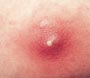 about boils