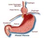 about hiatus hernia