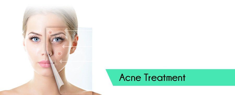 Acne-treatment