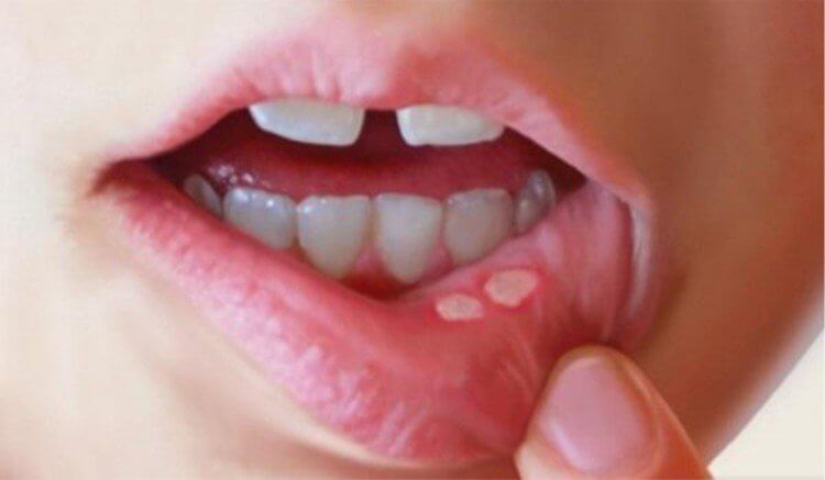 home remedies for mouth ulcers