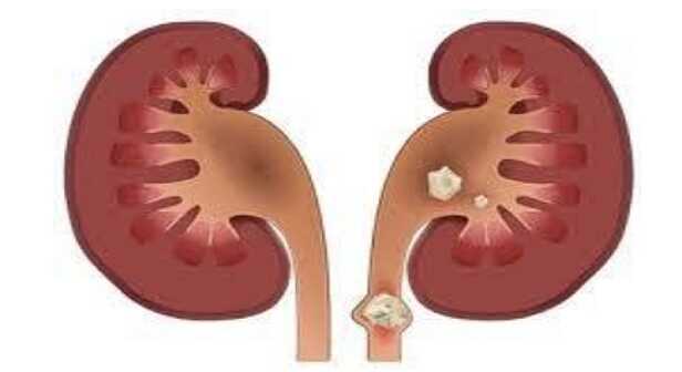 kidney stone new