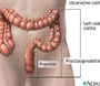 about colitis 11