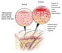 about eczema