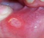 about mouth ulcers