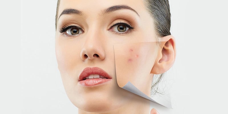 Acne Behandeling tegen Puistjes van Derma Care