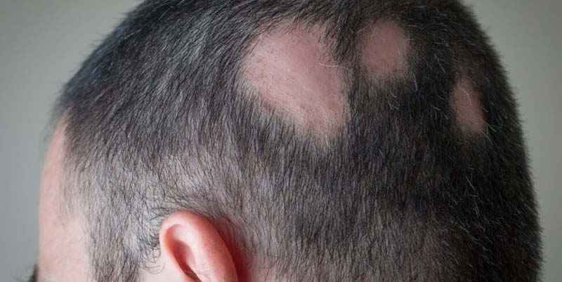 alopecia