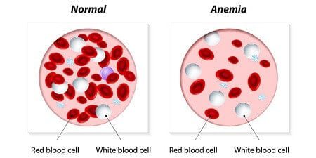 Anemia