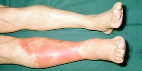 cellulitis diet