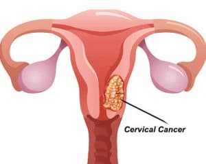 Cervical 300x240 1