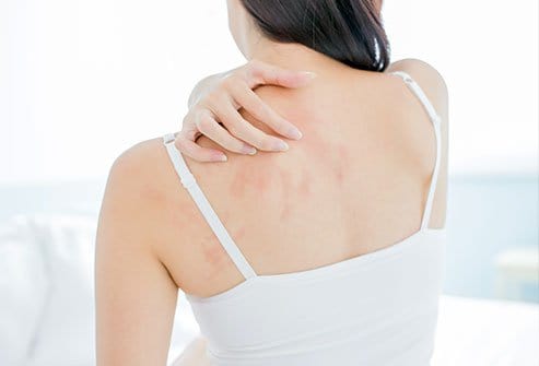 dermatitis vs eczema