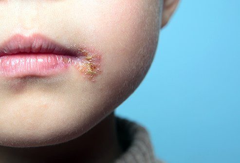 five things you should know about herpes