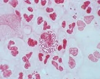 Gonorrhoea1 4