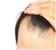 hairloss1