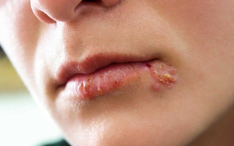 herpes