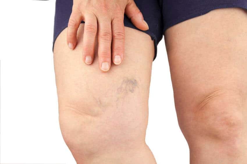 img the best natural remedies for varicose veins 1646 orig