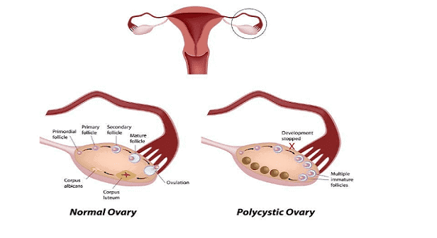 pcos new