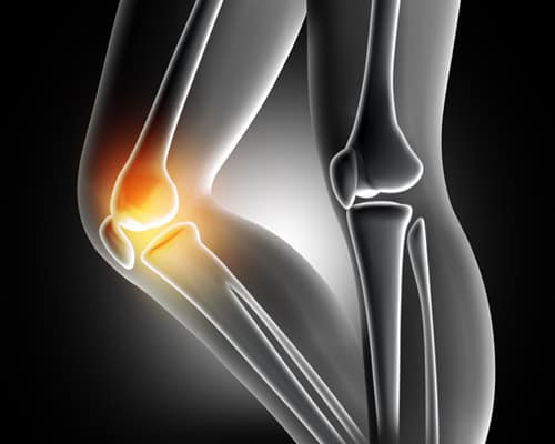 Things You Need to Know and Understand about Arthritis