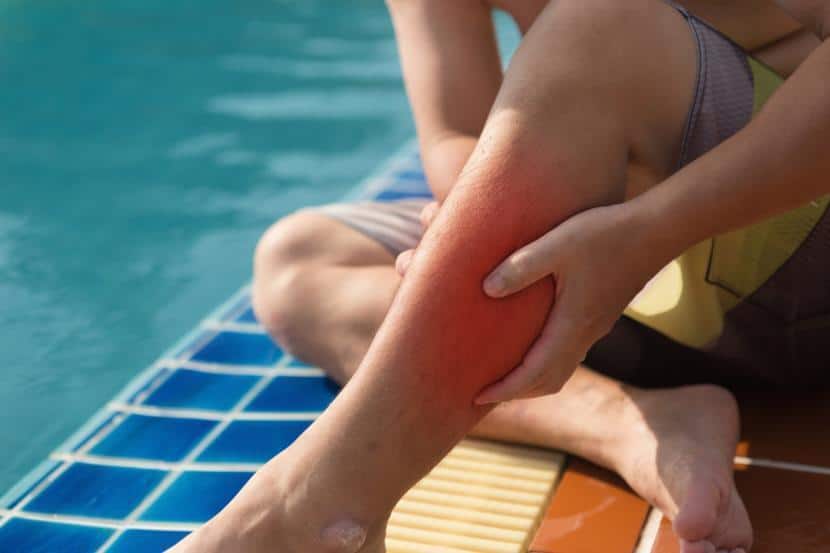 What Is Cellulitis Symptoms Causes and Treatments of Cellulitis