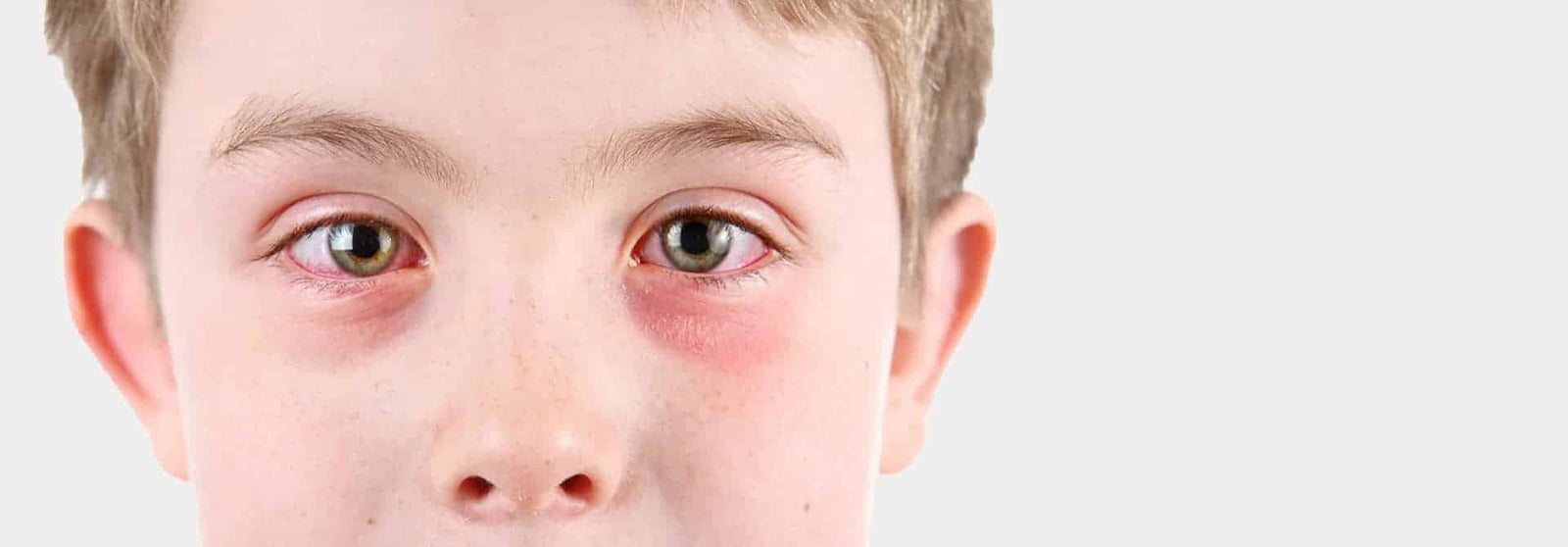 Hay fever